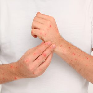 Natural Skin Rash Relief Balm with Ginger, Black Pepper & Cow Ghee